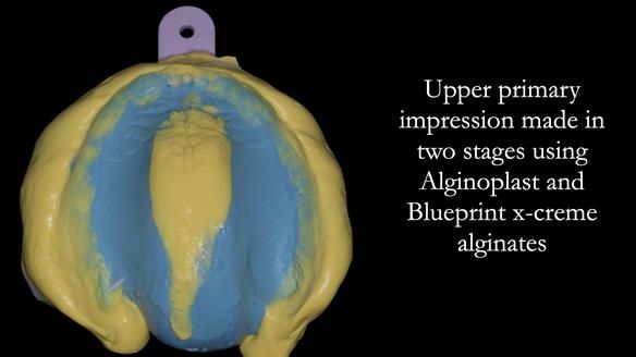 Newsletter 53 showing the making and fitting of ultra life-like dentures for Valena