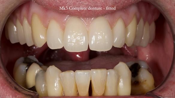 Newsletter 77: Jeremy’s case – immediate complete upper denture