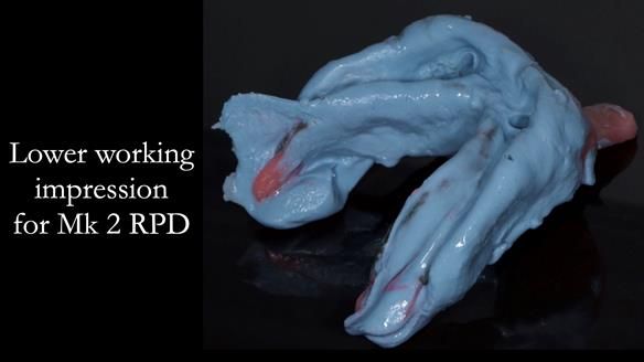 Finlay's Case Study Newsletter 40 - Immediate Mk 1 RPD to Definitive Mk 2 RPD - full protocol