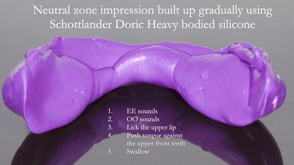 Replacing Madeline’s Complete denture FULL PROTOCOL