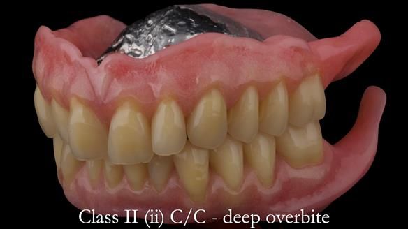 Complete denture Class II div 2 deep overbite Newsletter 39