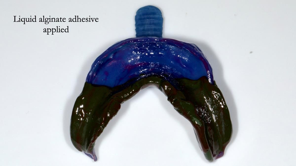 Newsletter 87 – Father Peter: A Partial Denture that needed Minor Miracle