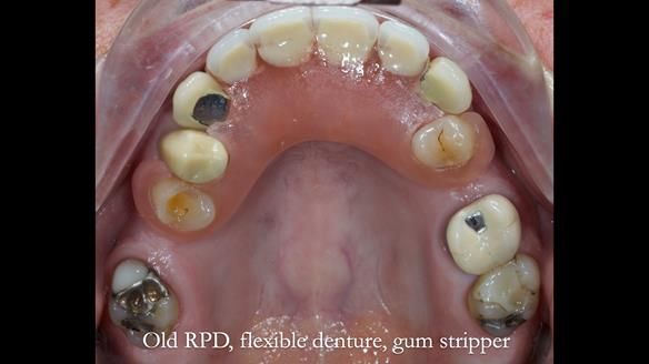 Newsletter 81 - Pam’s Story — how a partial denture changed her life (+ live walkthrough this Thursday)