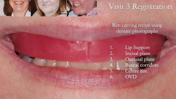Finlay's Newsletter 58 Gasket upper partial denture for Zoe