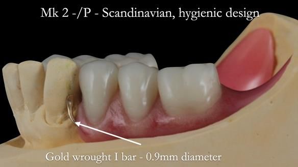 Newsletter 52 Managing Jo’s failing dentition with extractions and Mk 1/Mk 2 complete upper dentures and lower partial dentures FULL PROTOCOL