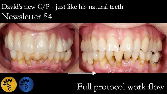 Newsletter 54 case presentation upper complete denture and lower Scandinavian designed hygienic partial denture for David
