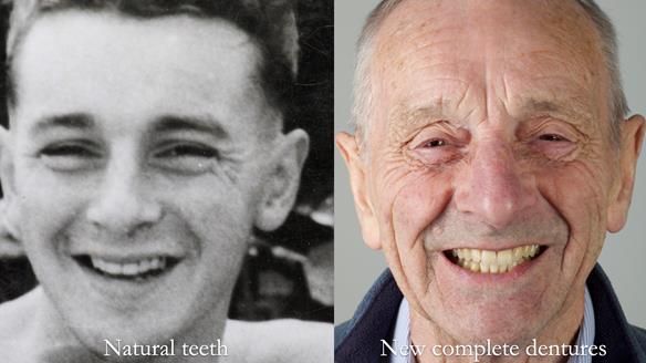 Newsletter 80 - Gordon’s dentures: the one case in 1,000 where my technique failed