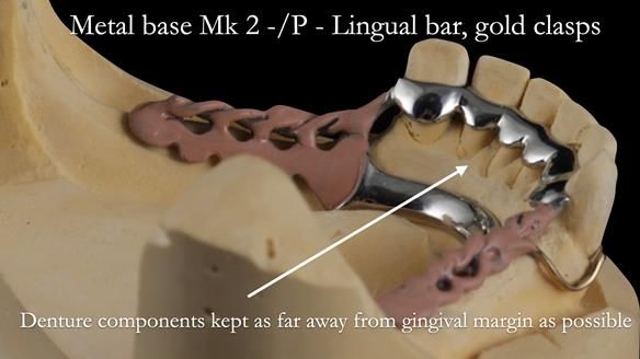 Newsletter 52 Managing Jo’s failing dentition with extractions and Mk 1/Mk 2 complete upper dentures and lower partial dentures FULL PROTOCOL