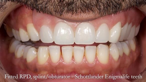 Upper metal base partial denture/occlusal stabilisation splint/obturator - full protocol