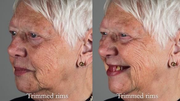 Finlay's Newsletter 59 Ultra hard partial dentures made for Gill