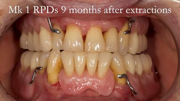 Finlay's Case Study Newsletter 40 - Immediate Mk 1 RPD to Definitive Mk 2 RPD - full protocol