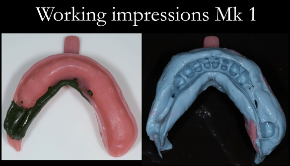 Figure 19 Working impression lower in custom tray with greenstick and alginate