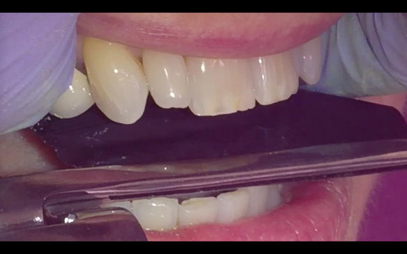 Figure 34 Occlusion check - Natural teeth to occlude in ICP in the same way with and without the denture.