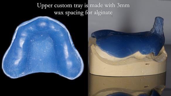 Newsletter 78: What do Clark Gable and a Locator® overdenture have in common?