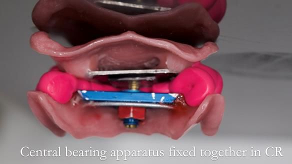 Solving Linda’s Failed “All on 4” implant bridges - full protocol Newsletter 42
