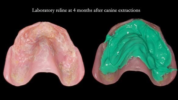 Newsletter 77: Jeremy’s case – immediate complete upper denture