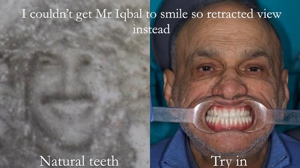 Managing poor implant positioning with complete dentures and Locator attachments - full protocol Newsletter 41