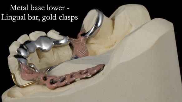 Newsletter 55 Provision of metal based partial dentures for Zephyrine with a repaired cleft lip and palate