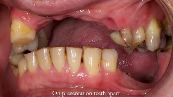 How Keith’s combat denture transformed his life – Newsletter 73