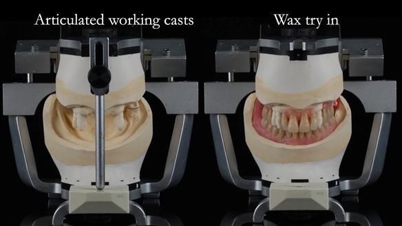 Finlay's Newsletter 59 Ultra hard partial dentures made for Gill
