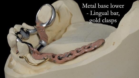 Newsletter 55 Provision of metal based partial dentures for Zephyrine with a repaired cleft lip and palate