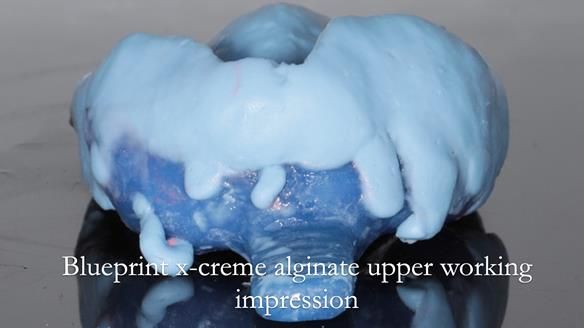 Newsletter 56 showing the making and fitting of a bilateral free end saddle upper removable partial denture (RPD) for patient with pemphigus
