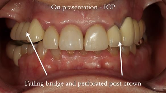 Newsletter 51 Managing Anne’s failing dentition with distal extension base RPD/Splint FULL PROTOCOL