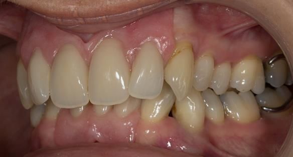Figure 80 Finished definitive partial dentures with knife edge flanges - replacing the missing gum tissue. Anterior path of insertion to give added retention