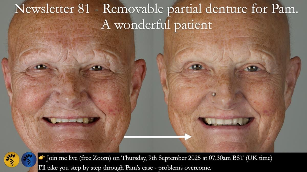 Newsletter 81 - Pam’s Story — how a partial denture changed her life (+ live walkthrough this Thursday)