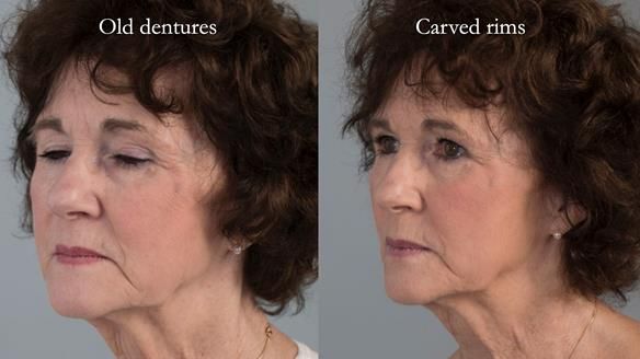 Newsletter 75: Marion’s case - Step-by-step complete denture workflow