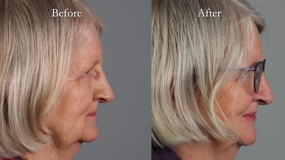 Newsletter 82 Mary - A complete upper and a one-tooth gasket denture