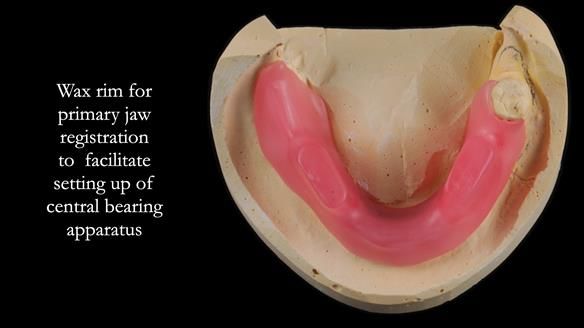 Finlay's Newsletter 59 Ultra hard partial dentures made for Gill