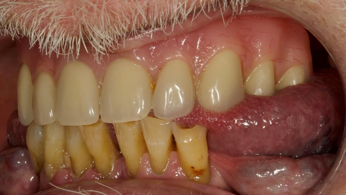 Newsletter 87 – Father Peter: A Partial Denture that needed Minor Miracle