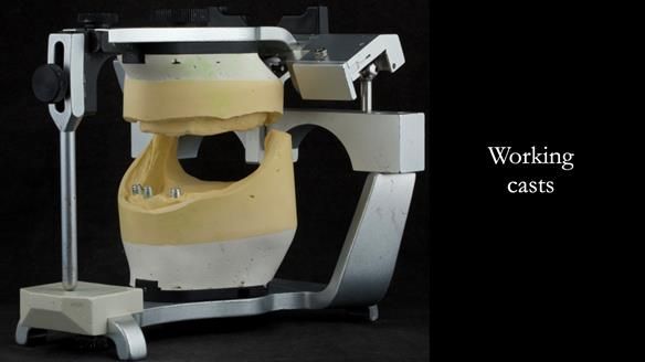 Working casts - class III skeletal relationship