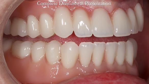 Newsletter 70 Complete Denture Treatment for Kate: A Case Study on Natural-Looking Dentures and Implant-Supported Overdentures