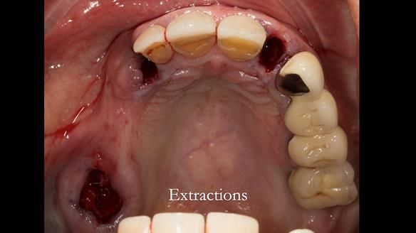 Newsletter 51 Managing Anne’s failing dentition with distal extension base RPD/Splint FULL PROTOCOL