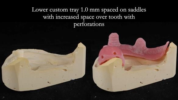 Finlay's Newsletter 59 Ultra hard partial dentures made for Gill