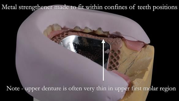 Newsletter 50 Special edition Complete Dentures FULL PROTOCOL