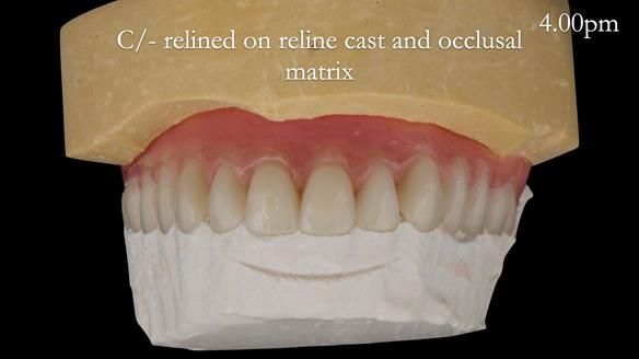 Newsletter 52 Managing Jo’s failing dentition with extractions and Mk 1/Mk 2 complete upper dentures and lower partial dentures FULL PROTOCOL