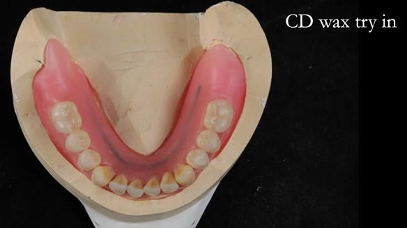 Finlay's Newsletter 62 provision of extractions and metal based complete dentures for Rafique