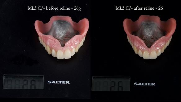 Newsletter 77: Jeremy’s case – immediate complete upper denture