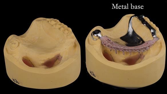 Upper metal base partial denture/occlusal stabilisation splint/obturator - full protocol