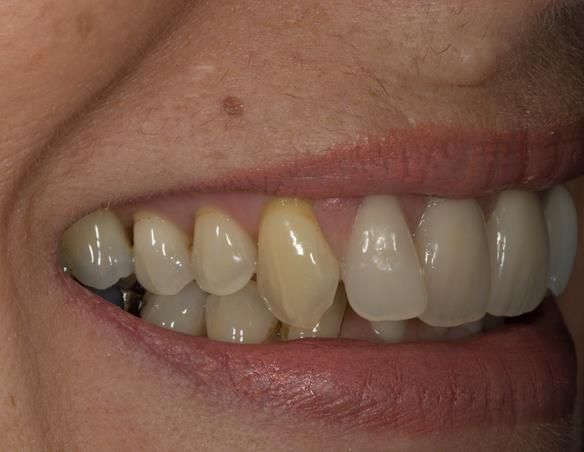Figure 83 Fitted cobalt chromium based partial dentures with Schottlander Enigmalife teeth