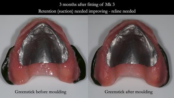 Newsletter 77: Jeremy’s case – immediate complete upper denture