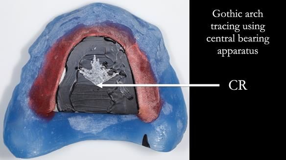 Finlay's Newsletter 62 provision of extractions and metal based complete dentures for Rafique