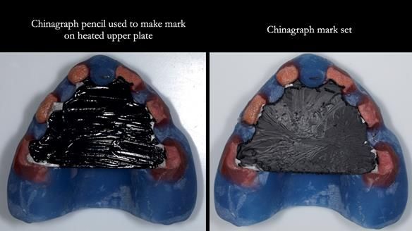 Newsletter 77: Jeremy’s case – immediate complete upper denture