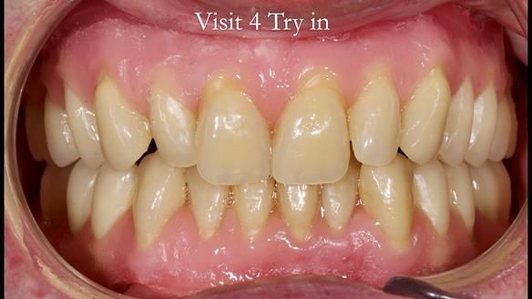 Complete denture Class II div 2 deep overbite Newsletter 39