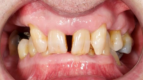 Newsletter 86 Peter the Architect — precision removable partial dentures case study