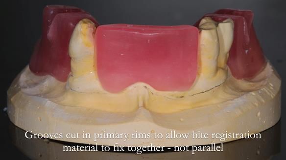 Finlay's Newsletter 59 Ultra hard partial dentures made for Gill