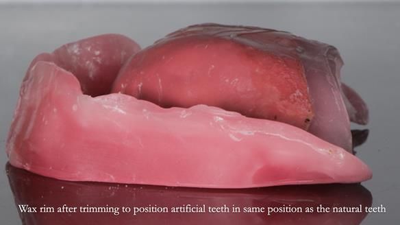 Finlay's Newsletter 62 provision of extractions and metal based complete dentures for Rafique